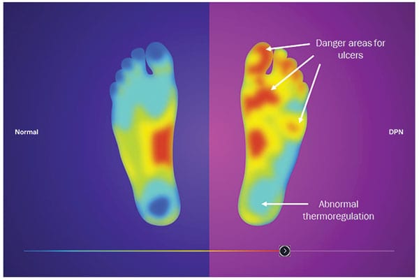 Photo of a diabetic foot image