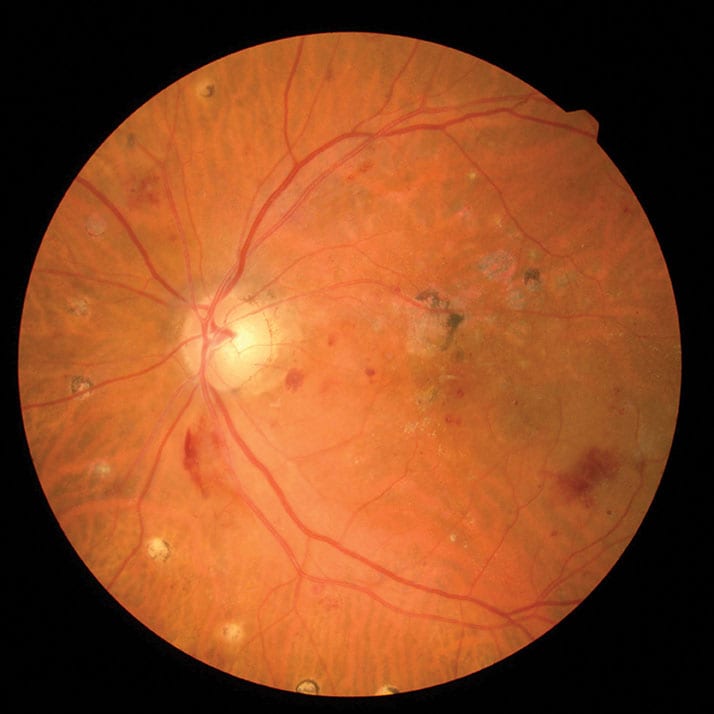 diabetic-retinopathy Photo of the eye